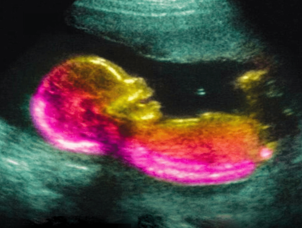 Cientistas podem ter descoberto uma das causas do autismo